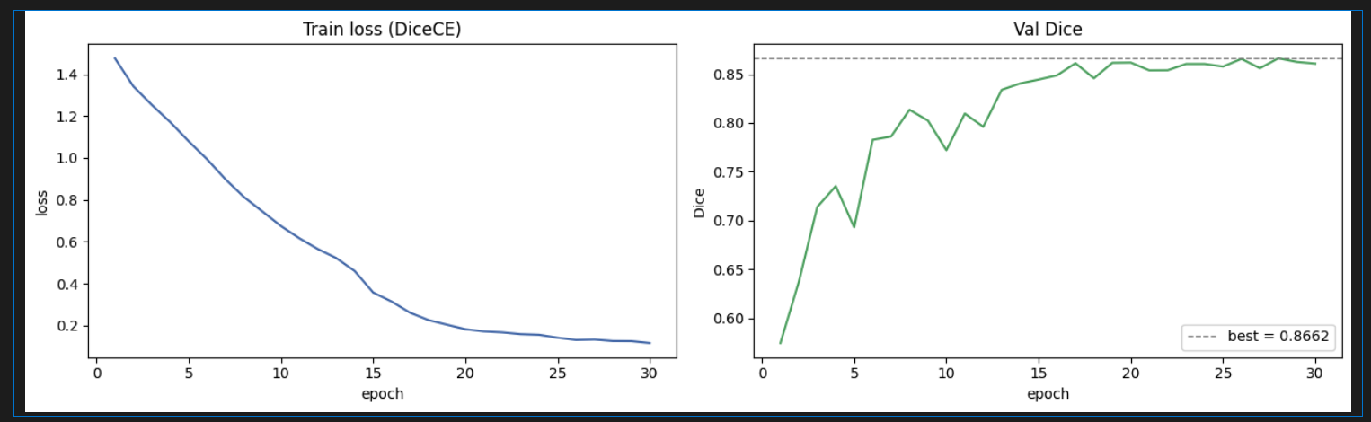 Training curves showing loss decreasing steadily over 30 epochs while validation Dice increases and plateaus around 0.866, indicating convergence with mild overfitting.